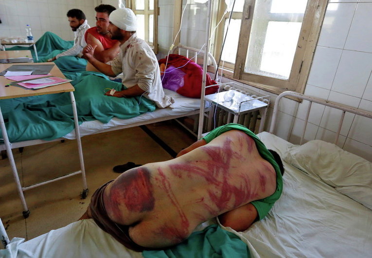 Мужчина показывает травмы, которые, по его словам, ему нанесли силы безопасности вблизи Сринагара при столкновениях в Кашмире