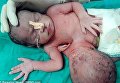Девочка со второй головой в области живота и 3 руками родилась в Индии
