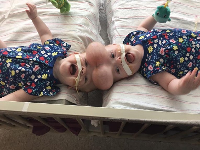 В США разъединили уникальных сиамских близнецов