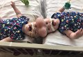 В США разъединили уникальных сиамских близнецов