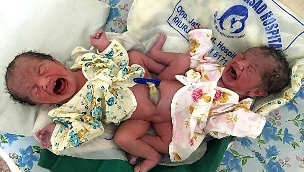 В Индии женщина родила сиамских близнецов непонятного пола