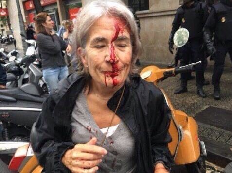 Референдум в Каталонии. Одна из пострадавших в результате действий полиции