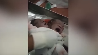 В Индии родился ребенок с двумя головами. Видео