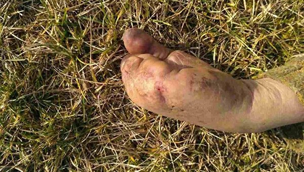 Рука без пальцев мужчины, чье тело было найдено в Кременчугском районе