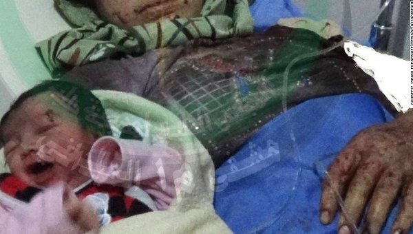 Новорожденная в Сирии с осколком снаряда в голове